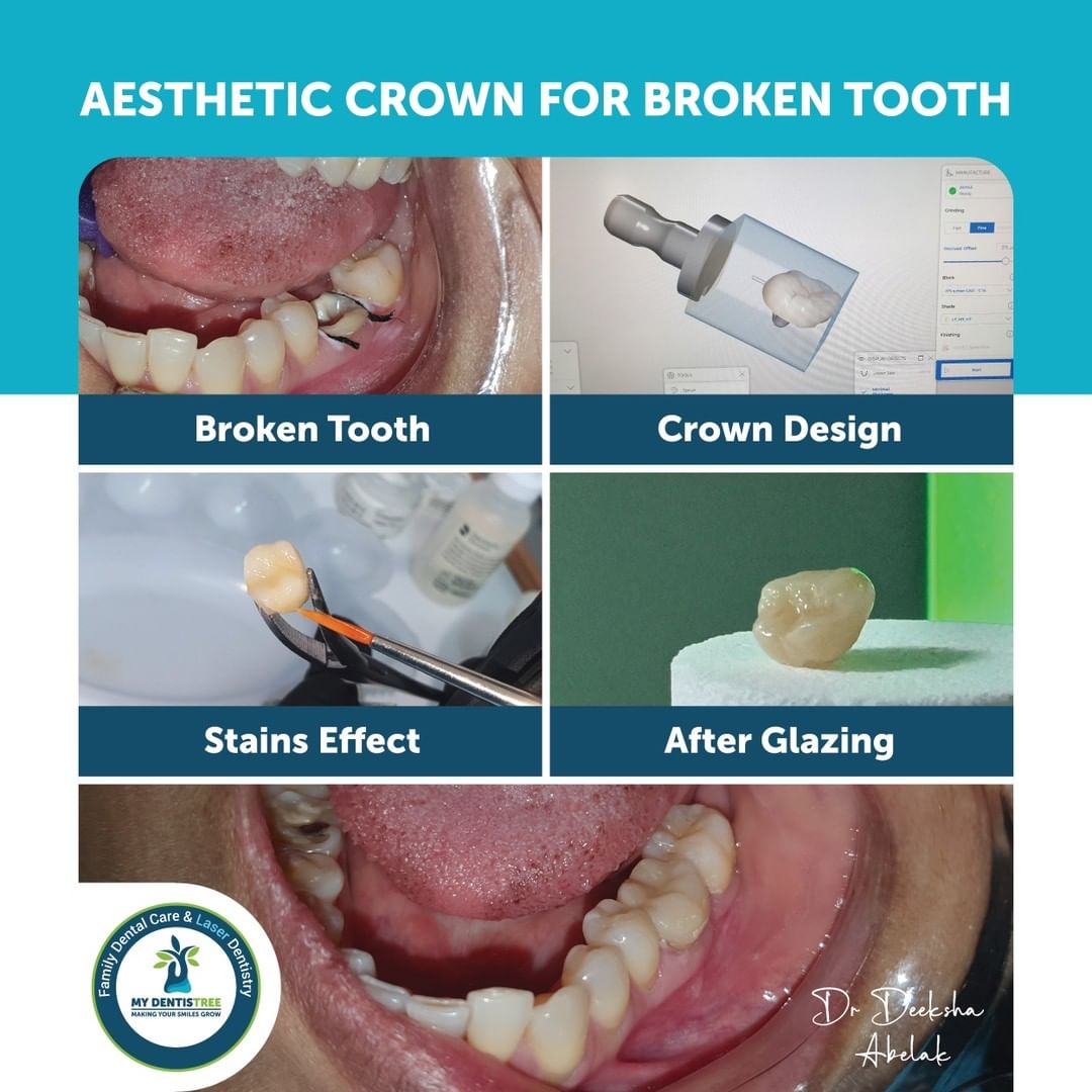 Ceramic crown with CEREC technology