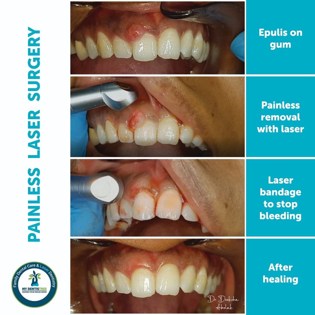 Painless Laser Surgery at My Dentistree