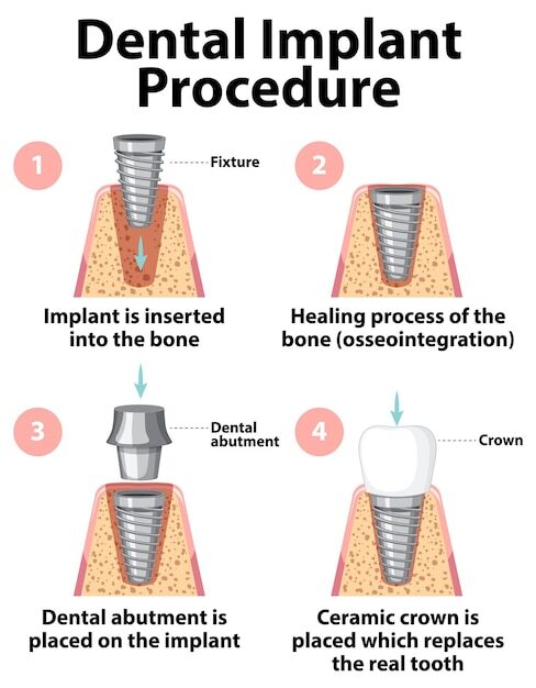 Dental Implant | My Dentistree